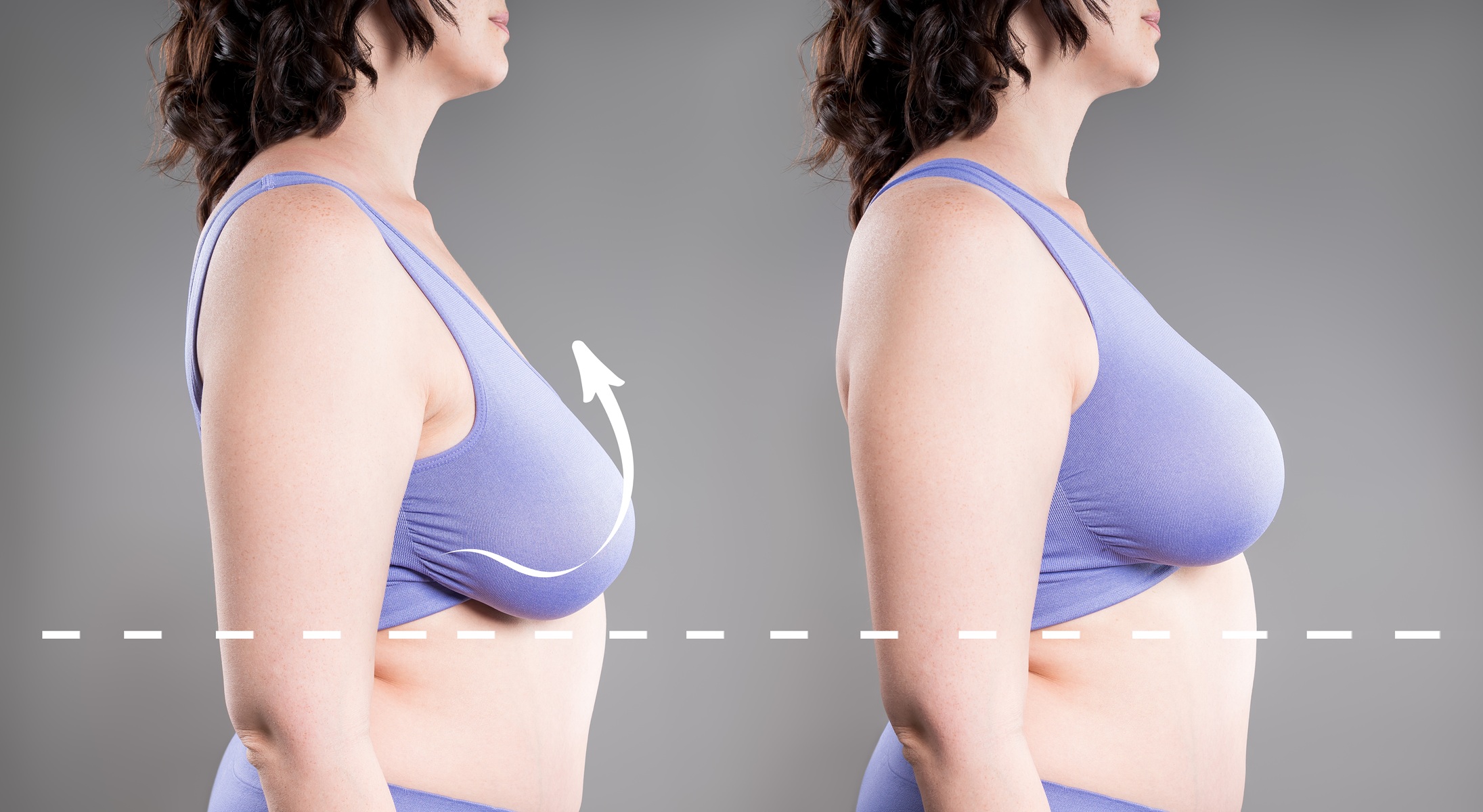 Zabiegi medycyny estetycznej, które pozwalają ujędrnić piersi i poprawić ich wygląd